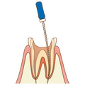 歯内治療