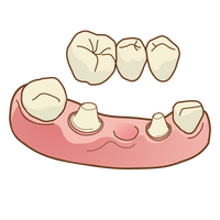むし歯の治療